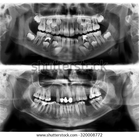 Panoramic dental x-ray tooth\'s of young man of 30 (thirty) and child of 7 (seven) years. Black and white image roentgen teeth upper and lower jaws of skull. The medical digital picture