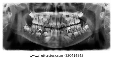 Panoramic dental x-ray of child of seven (7) years. Black and white image roentgen teeth upper and lower jaw skull of girl. Negative shot of the digital picture