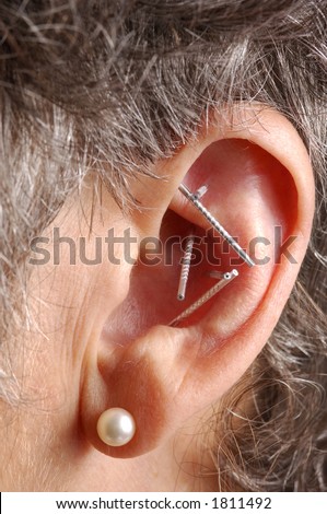 Acupuncture Needles in the ear