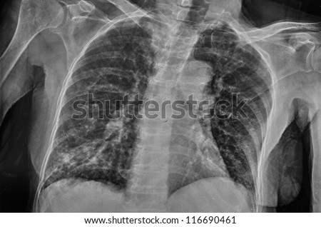 Interesting X-Ray film of female chest