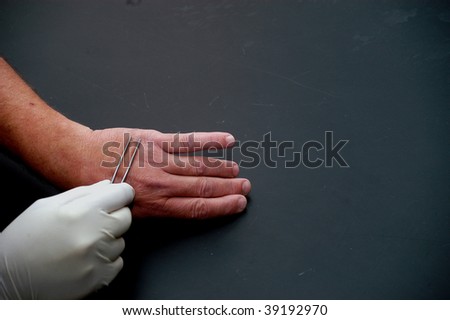 common wart images. hand. common wart on hand.