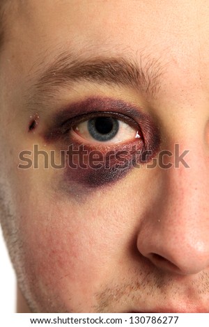 real eye bruise