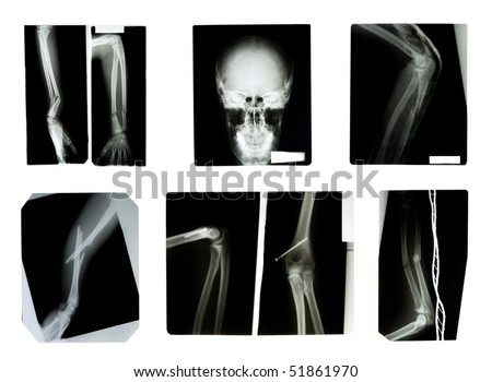 X-Rays Collection. Broken Bones Stock Photo 51861970 : Shutterstock