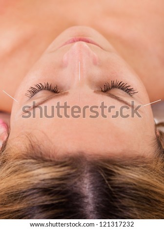 Woman undergoing acupuncture treatment with a line of fine needles inserted into the skin of her forehead