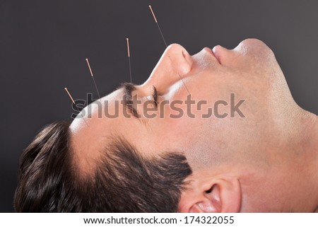 Close-up Of A Young Man Undergoing Acupuncture Treatment At Spa