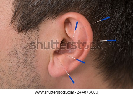 Close-up Of Acupuncture Needles On Man\'s Ear