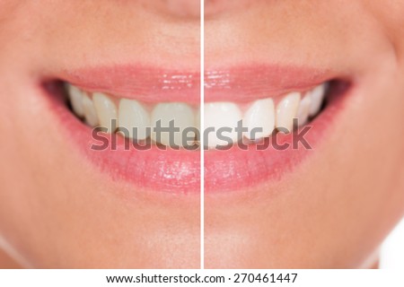 Close-up Of Woman Teeth Before And After Whitening