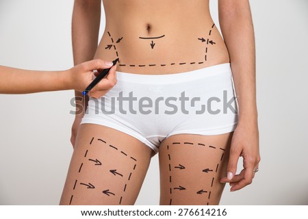 Person Hand Drawing Lines On Woman\'s Abdomen And Leg For Abdominal Cellulite Correction