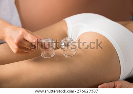 Close-up Of Therapist\'s Hand Placing Cups On Woman\'s Thigh
