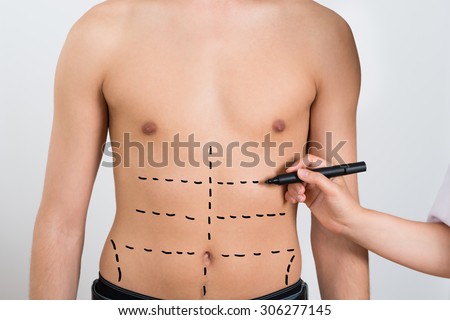 Close-up Of Person Hands Drawing Correction Lines On Abdomen Of Man
