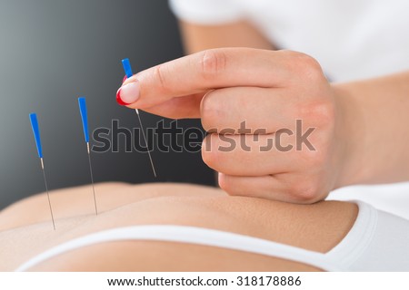 Close-up Of Therapist Hands Putting Acupuncture Needle On Woman\'s Back