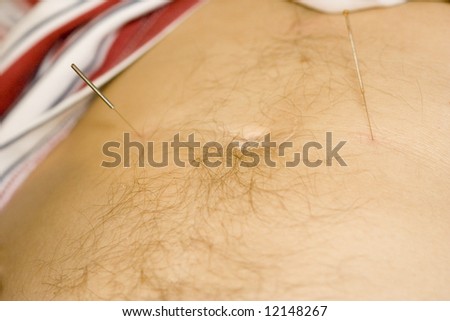 acupuncture treatment - man lying on back receiving acupuncture