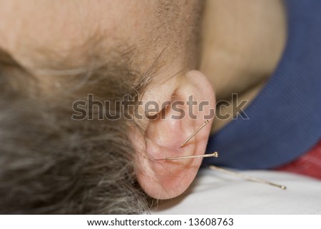 Man with acupuncture needles in his ear - close-up