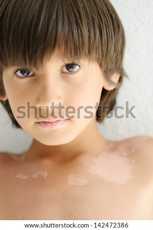 Kid having trouble with skin peeling