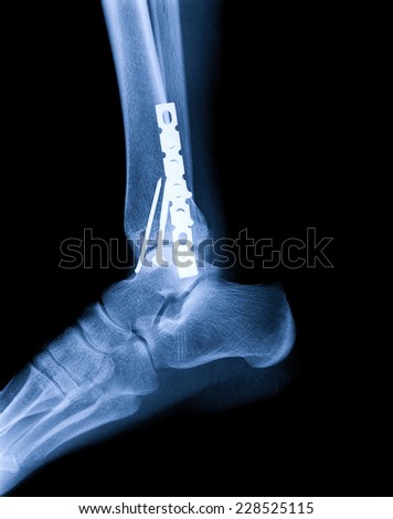 broken ankle