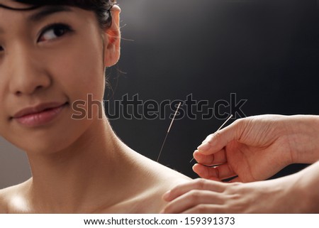 doctor putting acupuncture needles on woman\'s shoulder,close-up