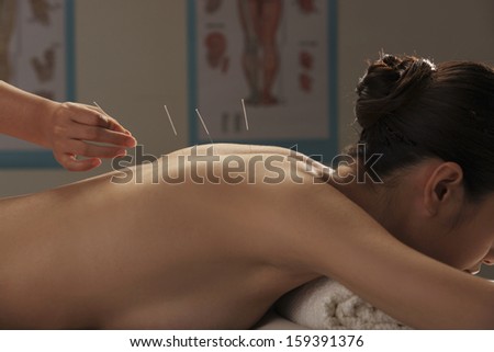 doctor putting acupuncture needles on woman\'s back, close-up