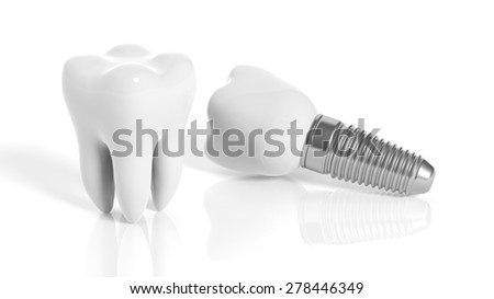 Tooth and dental implant isolated on white background Tooth and dental implant isolated on white background