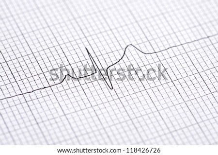 Closeup of twelve lead electrocardiogram graph showing ventrical activation time and amplitude