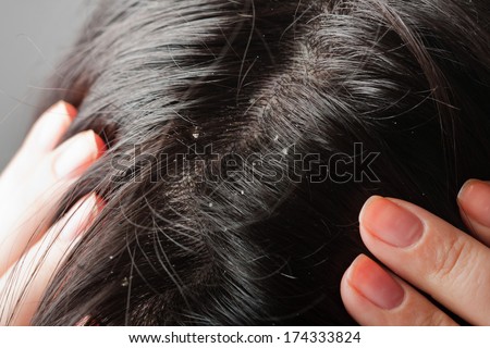 Persistent dandruff issue - flaky scalp