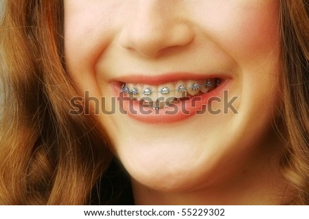 A womans smile with Braces