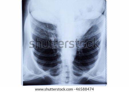 X-ray of the mature woman chest.