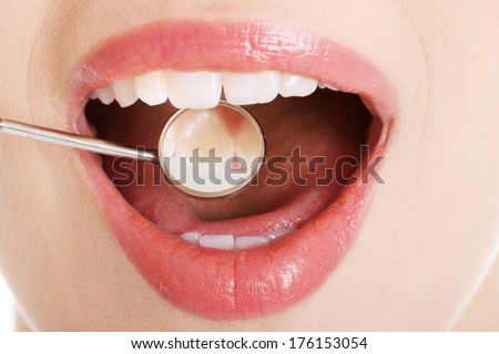 Close up on woman\'s open mouth with dental mirror.