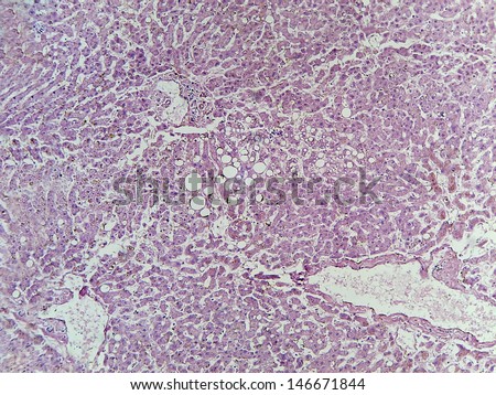 Micrograph of human liver tissue with characteristic vacuolization resulting from fat deposits.  Magnification 100x