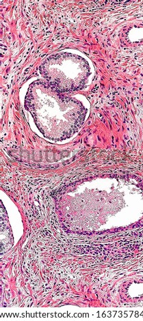 Prostatic tissue consistent with prostatitis.  The material within the ducts is detritus left over from the inflammation of the glandular tissue. Magnification 200x