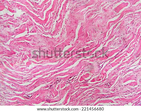 Micrograph of a elastofibroma, a fairly rare benign fibroblastic soft tissue tumor.
