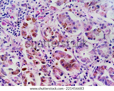 Hemochromotosis is genetic iron overload. Many patients are asymptomatic. Others must have blood drawn off. Here the accumulation of hemosiderin is obvious in the cytoplasm of these stomach cells.