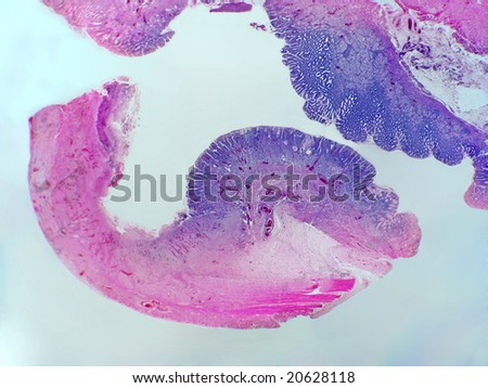 histological image of the area of a stomach ulcer