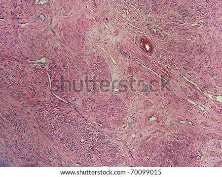 Microscopic view (100x) of benign uterine tumor (fibromyoma) made up of smooth muscle.  Muscle fibers in both the transverse and long axis.  This is a very common tumor of mid to late life in females.