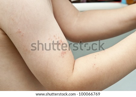 Blisters caused by herpes zoster in the hand and arm of a child.
