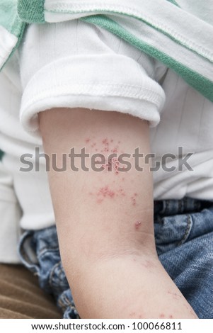 Blisters caused by herpes zoster in the hand and arm of a child.