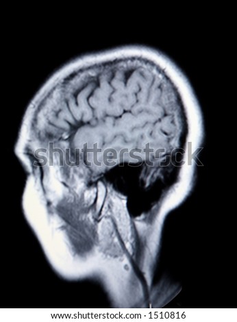 A real MRI/ MRA (Magnetic Resonance Angiogram) of the brain in monochrome
