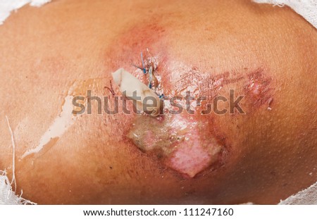 open wound on his knee