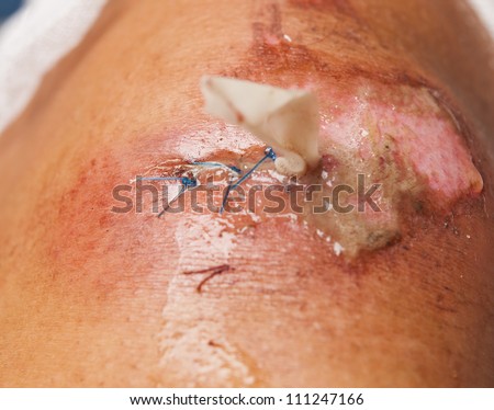 open wound on his knee