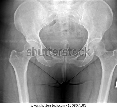 X-ray of the hip prosthesis elderly man