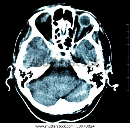 brain tomography