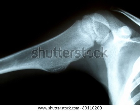 X-Ray Bone Pathology Stock Photo 60110200 : Shutterstock X-Ray Bone Pathology Stock Photo 60110200 : Shutterstock