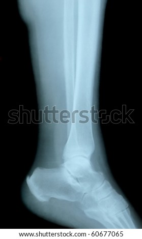 osteoporosis x ray. x-ray Osteoporosis foot