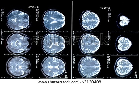 magnetic resonance (MR) scan brain and skull
