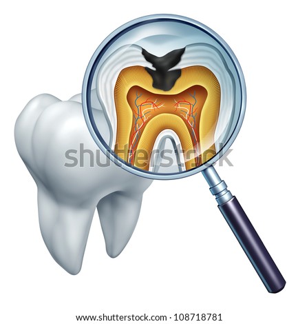Tooth cavity close up and cavities symbol showing a magnifying glass with a cross section of a tooth anatomy in decay due to bacteria and acids in oral health care showing rotting and disease Tooth cavity close up and cavities symbol showing a magnifying glass with a cross section of a tooth anatomy in decay due to bacteria and acids in oral health care showing rotting and disease