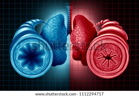 Asthma health diagnosis as a diagram with a healthy and unhealthy bronchial tube with a constricted breathing  problem caused by respiratory muscle tightening with 3D illustration elements.