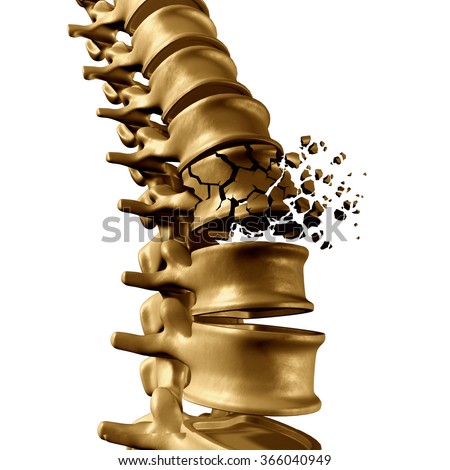 Spinal Fracture and traumatic vertebral injury medical concept as a human anatomy spinal column with a broken burst vertebra due to compression and osteoporosis back disease on a white background.