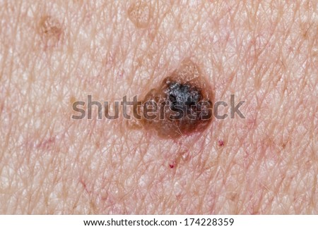 Suspicious Mole on Skin For Cancer
