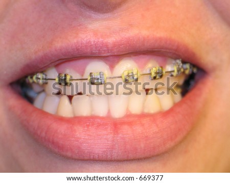 Mouth with bracket braces, no overexposure on the metal.