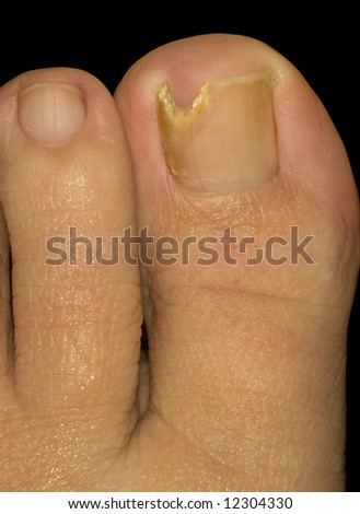 Toe Nail Suffering from Fungus infection. This is an image useful for medical and podologist brochures. Shot with Macro Lens.