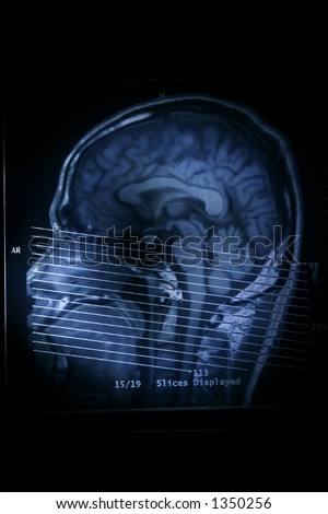 A magnetic resonance imaging scan of the human head.
